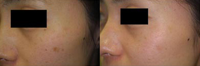 Click Here to View More Vbeam Perfecta Before & After Photos