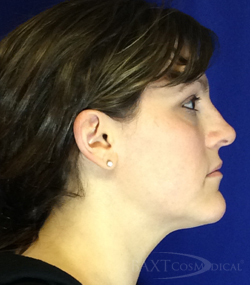 Ultherapy® Treatment After - Paramus, NJ Ultherapy® Treatment After - Paramus, NJ