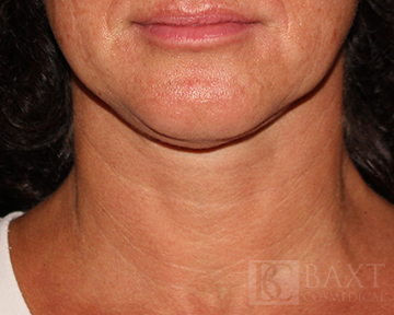 Closeup of patient Before Ultherapy®