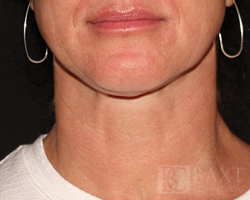Closeup of patient after Ultherapy®