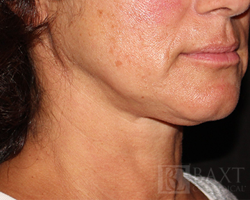 Closeup of patient before Ultherapy®