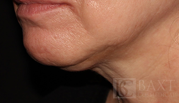 Ultherapy® Treatment Before - Paramus, NJ