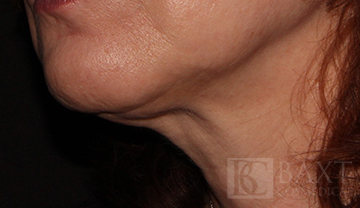Ultherapy® Treatment After - Paramus, NJ Ultherapy® Treatment After - Paramus, NJ