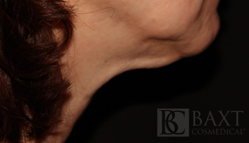 Ultherapy® Treatment Before - Paramus, NJ Ultherapy® Treatment Before - Paramus, NJ