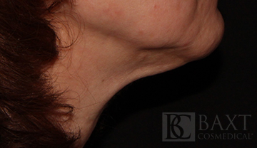 Ultherapy® Treatment After - Paramus, NJ Ultherapy® Treatment After - Paramus, NJ