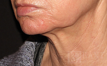 Ultherapy® Treatment Before - Paramus, NJ Ultherapy® Treatment Before - Paramus, NJ