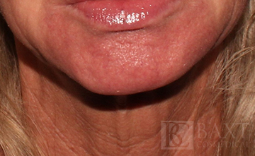 Ultherapy® Treatment After - Paramus, NJ Ultherapy® Treatment After - Paramus, NJ