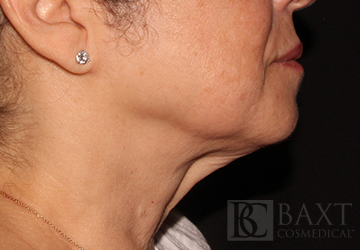 Ultherapy® Treatment Before - Paramus, NJ Ultherapy® Treatment Before - Paramus, NJ
