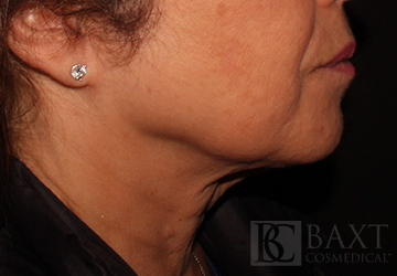 Ultherapy® Treatment After - Paramus, NJ Ultherapy® Treatment After - Paramus, NJ
