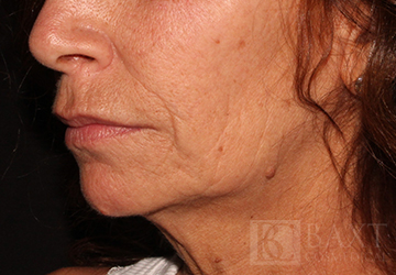 Ultherapy® Treatment Before - Paramus, NJ Ultherapy® Treatment Before - Paramus, NJ