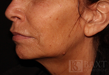 Ultherapy® Treatment After - Paramus, NJ Ultherapy® Treatment After - Paramus, NJ