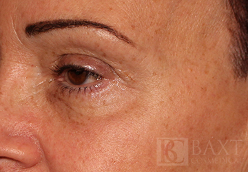 Ultherapy® Treatment After - Paramus, NJ
