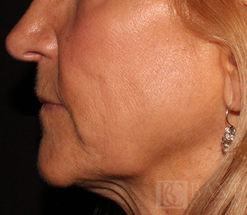 Ultherapy® Treatment Before - Paramus, NJ Ultherapy® Treatment Before - Paramus, NJ