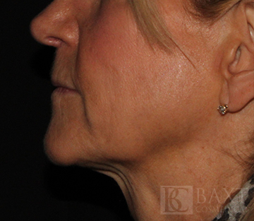 Ultherapy® Treatment After - Paramus, NJ