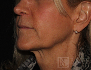 Ultherapy® Treatment After - Paramus, NJ Ultherapy® Treatment After - Paramus, NJ
