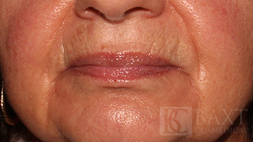 Ultherapy® Treatment Before - Paramus, NJ Ultherapy® Treatment Before - Paramus, NJ