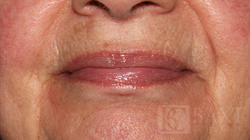 Ultherapy® Treatment After - Paramus, NJ Ultherapy® Treatment After - Paramus, NJ