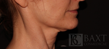 Ultherapy® Treatment Before - Paramus, NJ Ultherapy® Treatment Before - Paramus, NJ