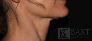 Ultherapy® Treatment After - Paramus, NJ Ultherapy® Treatment After - Paramus, NJ
