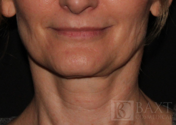 Ultherapy® Treatment After - Paramus, NJ Ultherapy® Treatment After - Paramus, NJ