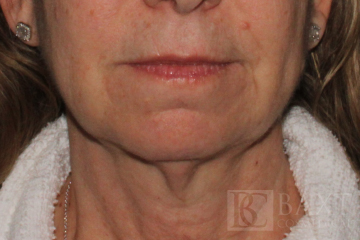 Ultherapy® Treatment After - Paramus, NJ Ultherapy® Treatment After - Paramus, NJ