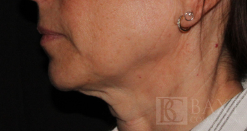Ultherapy® Treatment Before - Paramus, NJ Ultherapy® Treatment Before - Paramus, NJ