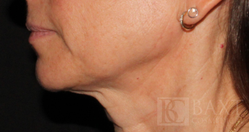 Ultherapy® Treatment After - Paramus, NJ Ultherapy® Treatment After - Paramus, NJ