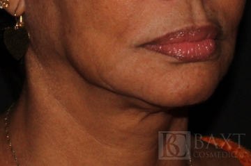 Ultherapy® Treatment Before - Paramus, NJ Ultherapy® Treatment Before - Paramus, NJ