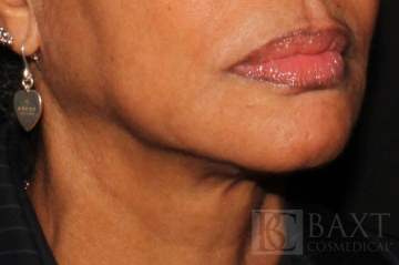 Ultherapy® Treatment After - Paramus, NJ Ultherapy® Treatment After - Paramus, NJ