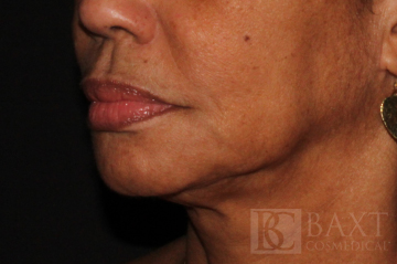 Ultherapy® Treatment Before - Paramus, NJ Ultherapy® Treatment Before - Paramus, NJ