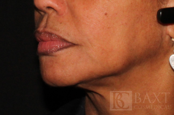 Ultherapy® Treatment After - Paramus, NJ Ultherapy® Treatment After - Paramus, NJ