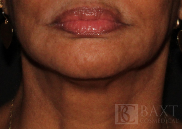 Ultherapy® Treatment Before - Paramus, NJ Ultherapy® Treatment Before - Paramus, NJ
