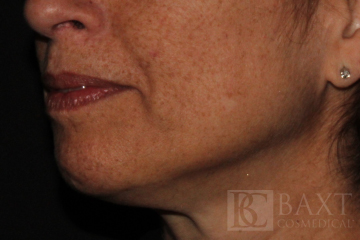 Ultherapy® Treatment Before - Paramus, NJ Ultherapy® Treatment Before - Paramus, NJ