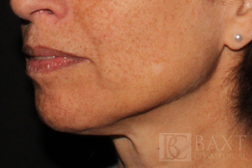 Ultherapy® Treatment After - Paramus, NJ Ultherapy® Treatment After - Paramus, NJ