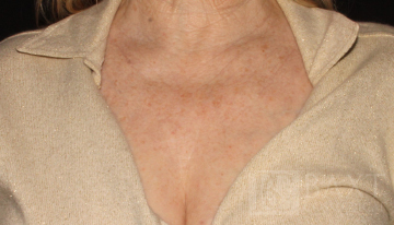 Ultherapy® Treatment After - Paramus, NJ Ultherapy® Treatment After - Paramus, NJ