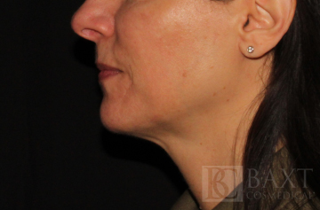 Ultherapy® Treatment After - Paramus, NJ Ultherapy® Treatment After - Paramus, NJ