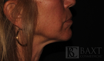Ultherapy® Treatment Before - Paramus, NJ Ultherapy® Treatment Before - Paramus, NJ