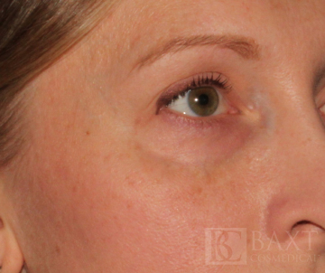 Ultherapy® Treatment Before - Paramus, NJ