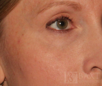 Ultherapy® Treatment After - Paramus, NJ