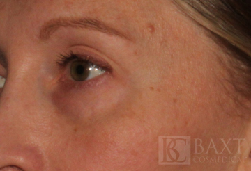Ultherapy® Treatment Before - Paramus, NJ