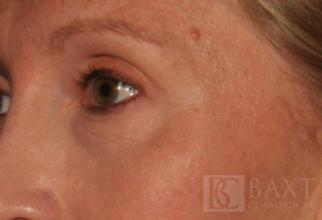 Ultherapy® Treatment After - Paramus, NJ