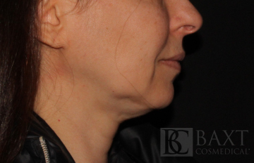 Ultherapy® Treatment Before - Paramus, NJ