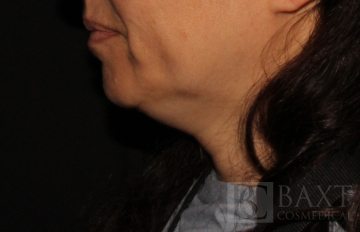 Ultherapy® Treatment Before - Paramus, NJ