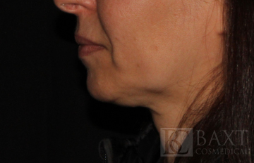 Ultherapy® Treatment After - Paramus, NJ