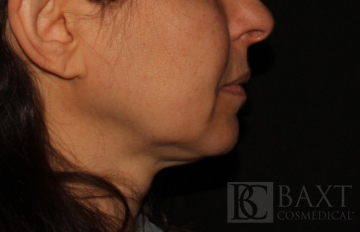 Ultherapy® Treatment Before - Paramus, NJ