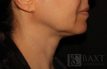 Ultherapy® Treatment After - Paramus, NJ