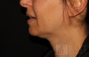 Ultherapy® Treatment After - Paramus, NJ
