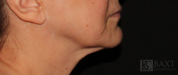 Ultherapy® Treatment Before - Paramus, NJ