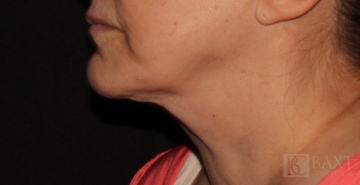 Ultherapy® Treatment Before - Paramus, NJ