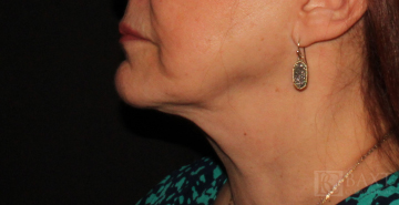 Ultherapy® Treatment After - Paramus, NJ